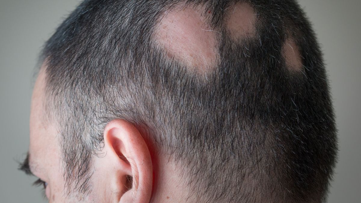 Discover what hair loss means, rụng tóc tiếng anh là gì and how to treat it