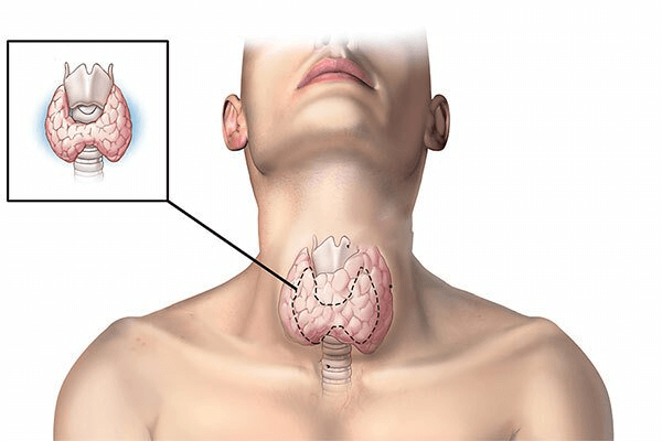 What are the treatment options for goitre?
