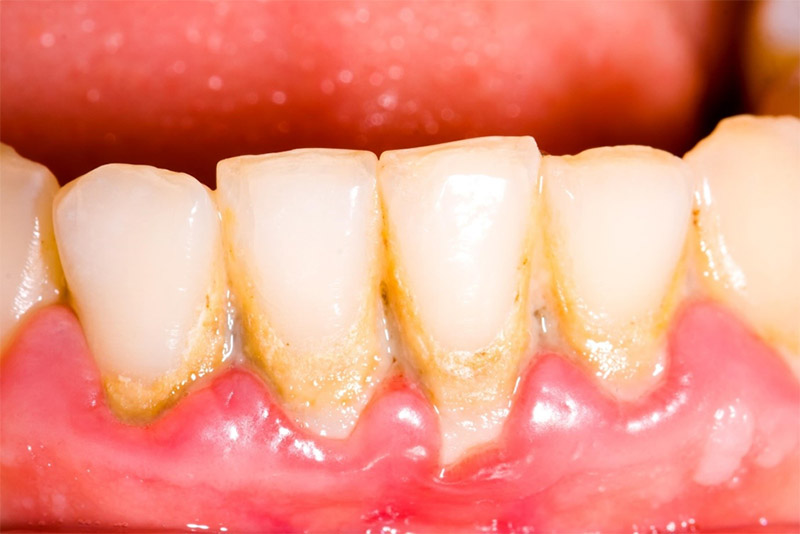 Tiếng Anh của thuật ngữ dental implant là gì?
