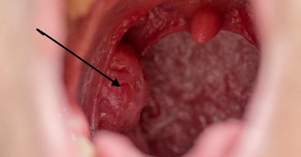 Tonsillitis trong tiếng Anh có nghĩa là gì và liên quan đến amidan như thế nào?
