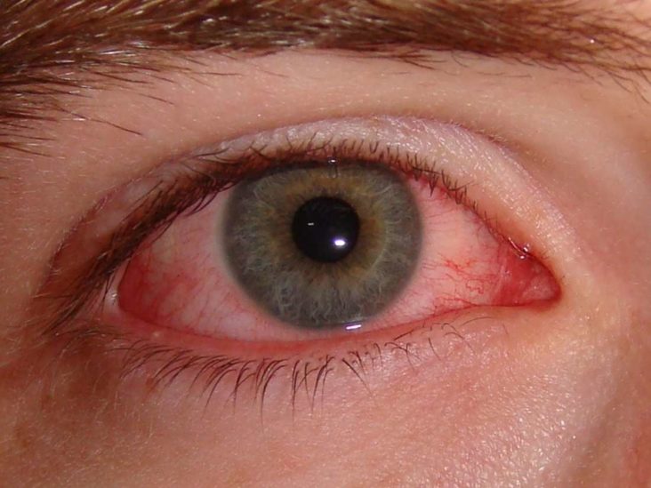 Tìm hiểu đau mắt tiếng anh là gì - Dấu hiệu và cách điều trị