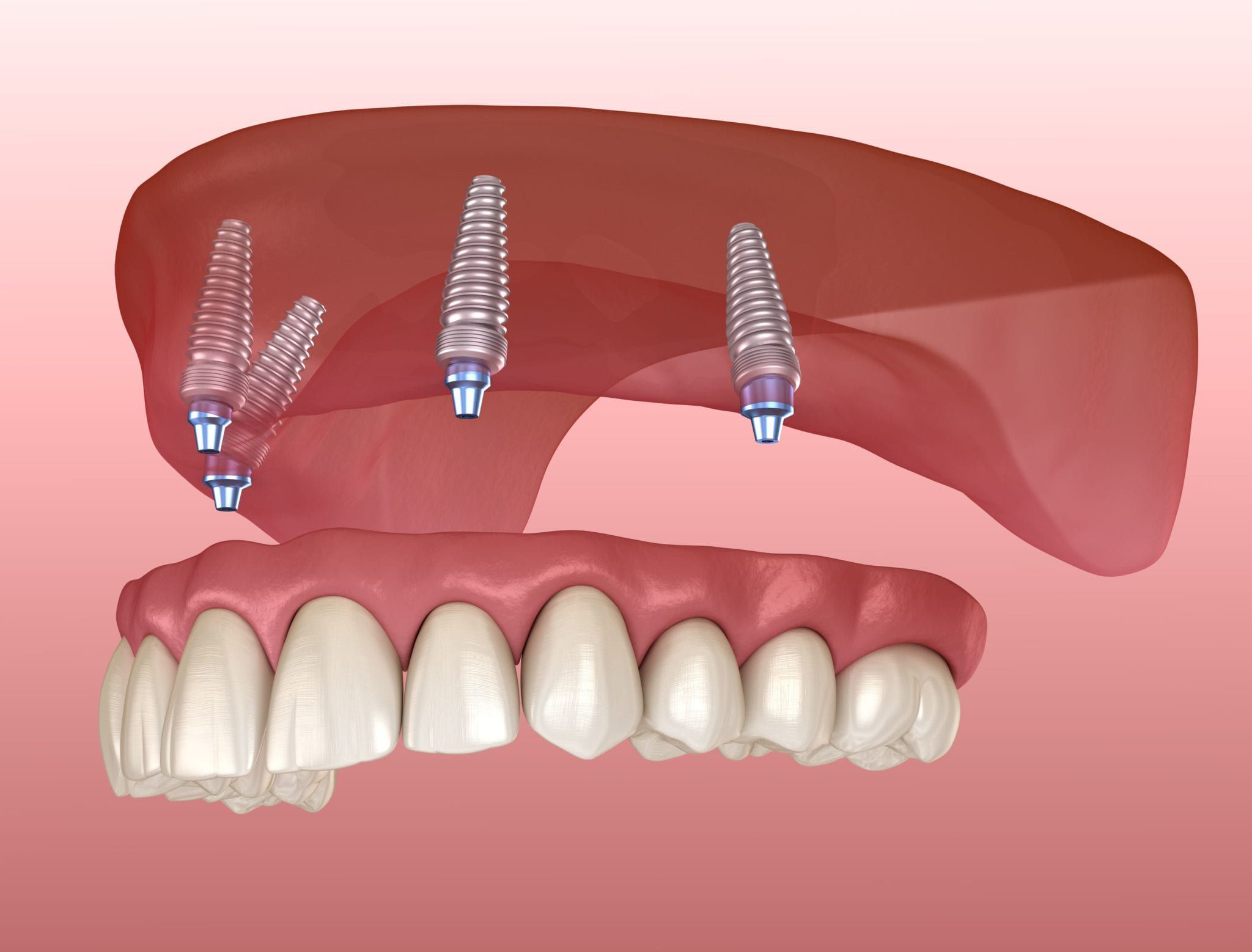 Răng giả và dental prosthesis nghĩa là gì trong tiếng Anh?
