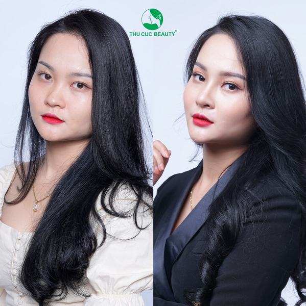 NÂNG MŨI BẰNG TIẾNG ANH GỌI LÀ RHINOPLASTY