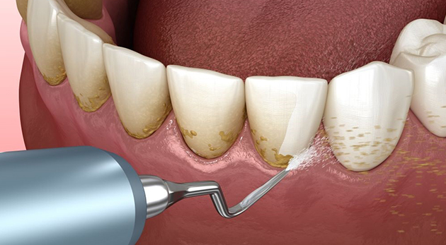 Những nguyên nhân gây ra cạo vôi răng?
