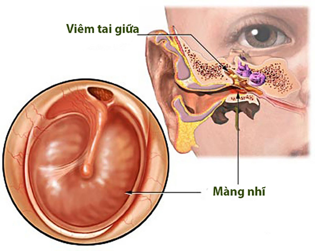 Viêm tai giữa cấp thường do vi khuẩn hoặc virut gây ra, phải không? (Acute otitis media is usually caused by bacteria or viruses, right?)
