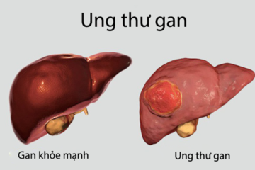What is ung thư gan tiếng anh là gì Overview and Treatment Options
