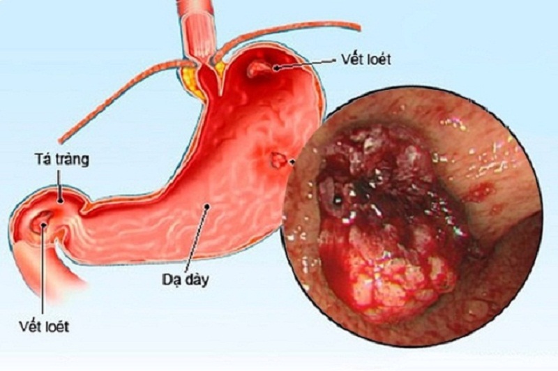 Viêm Dạ Dày Tiếng Anh: Nguyên Nhân, Triệu Chứng và Cách Điều Trị Hiệu Quả