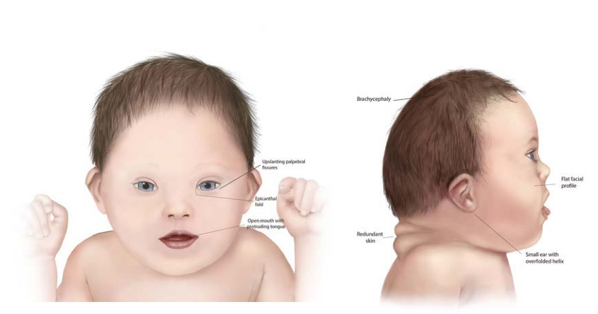 research article on trisomy 21