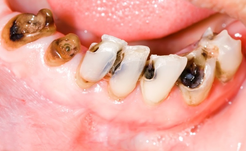 Cách điều trị sâu răng trong Tiếng Anh là gì?
